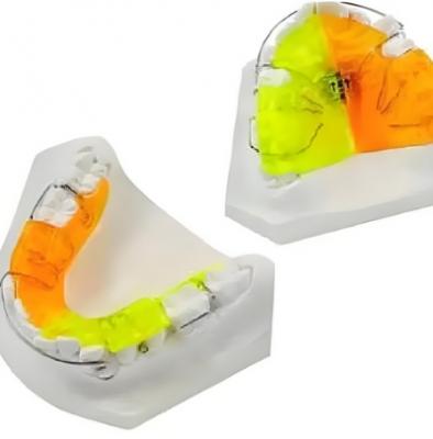 登特菲定制式正畸矯治器零售價